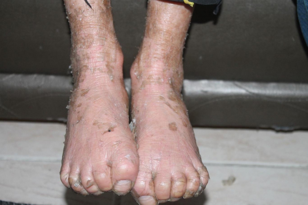 Lamellar İktiyozis Hastası 8 Yaşındaki Melih  iyileşmeye Başladı 1