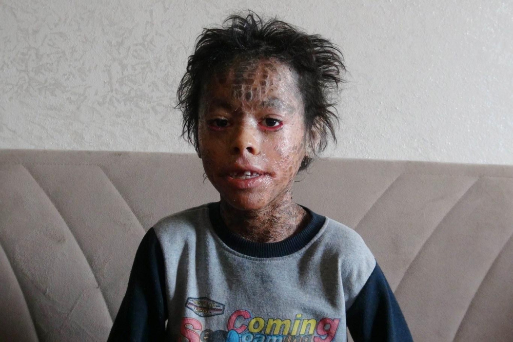 Lamellar İktiyozis Hastası 8 Yaşındaki Melih  iyileşmeye Başladı 10