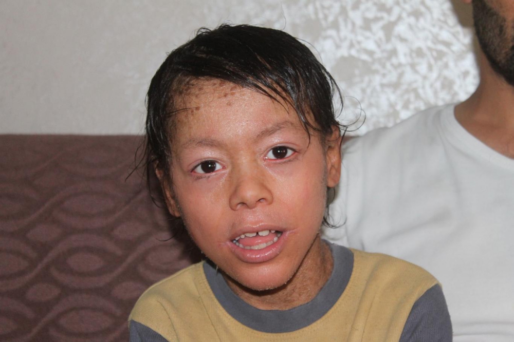 Lamellar İktiyozis Hastası 8 Yaşındaki Melih  iyileşmeye Başladı 12