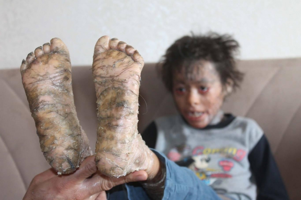 Lamellar İktiyozis Hastası 8 Yaşındaki Melih  iyileşmeye Başladı 2