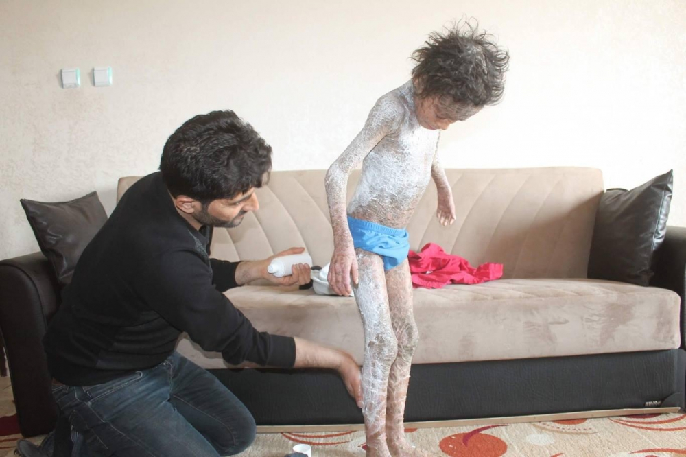 Lamellar İktiyozis Hastası 8 Yaşındaki Melih  iyileşmeye Başladı 3