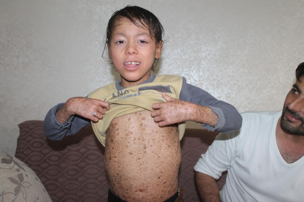 Lamellar İktiyozis Hastası 8 Yaşındaki Melih  iyileşmeye Başladı 4