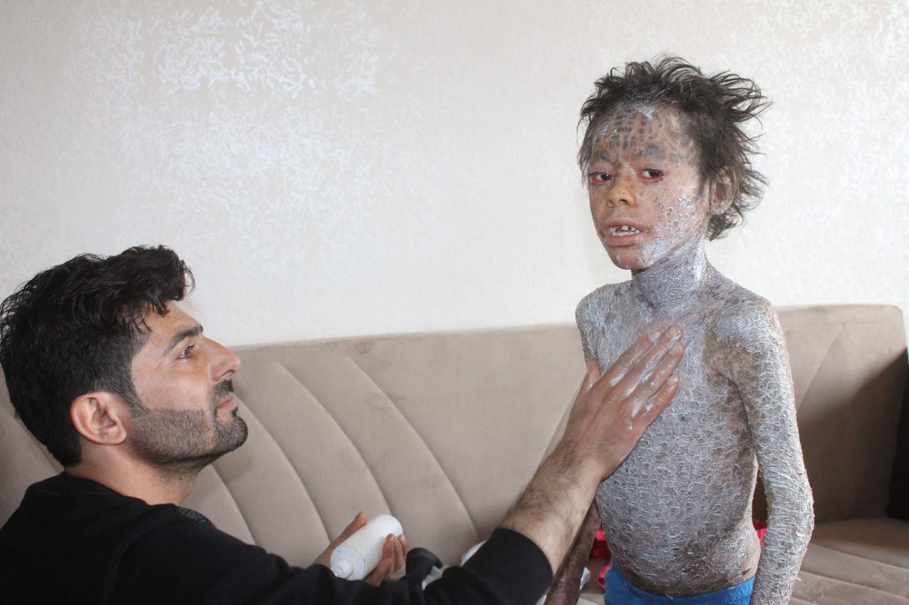 Lamellar İktiyozis Hastası 8 Yaşındaki Melih  iyileşmeye Başladı 5