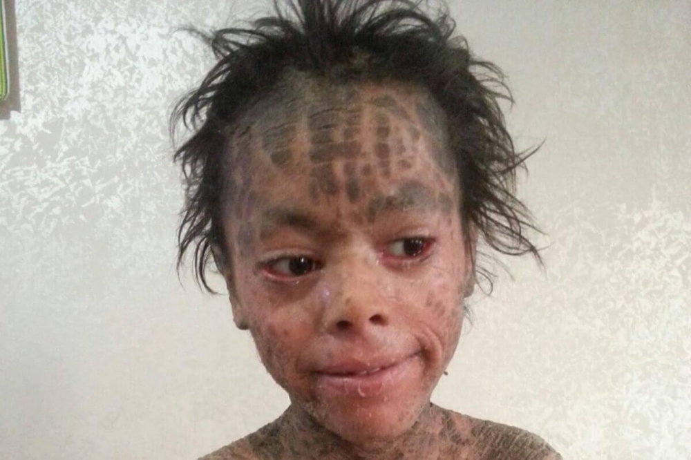 Lamellar İktiyozis Hastası 8 Yaşındaki Melih  iyileşmeye Başladı 6