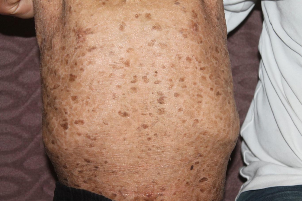 Lamellar İktiyozis Hastası 8 Yaşındaki Melih  iyileşmeye Başladı 7