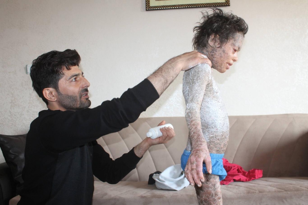 Lamellar İktiyozis Hastası 8 Yaşındaki Melih  iyileşmeye Başladı 8