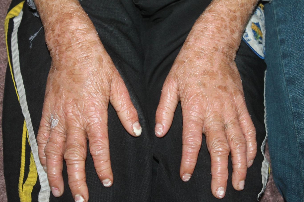 Lamellar İktiyozis Hastası 8 Yaşındaki Melih  iyileşmeye Başladı 9