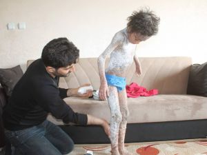 Lamellar İktiyozis Hastası 8 Yaşındaki Melih  iyileşmeye Başladı